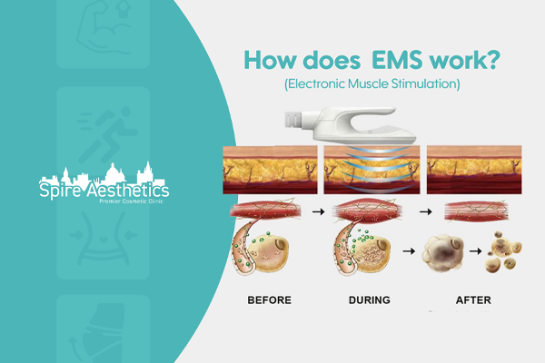 EMS treatment for post pregnancy weight loss treatment Westminster