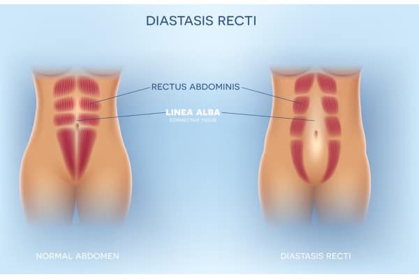 What Non-Surgical Options Are Available for Diastasis Recti Westminster?