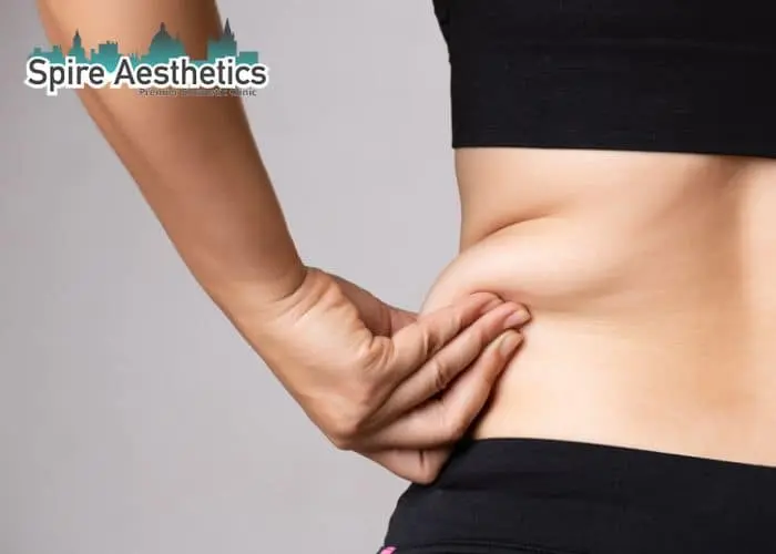 Image of woman pinching fat on their hips Westminster. Fat Freezing treatment