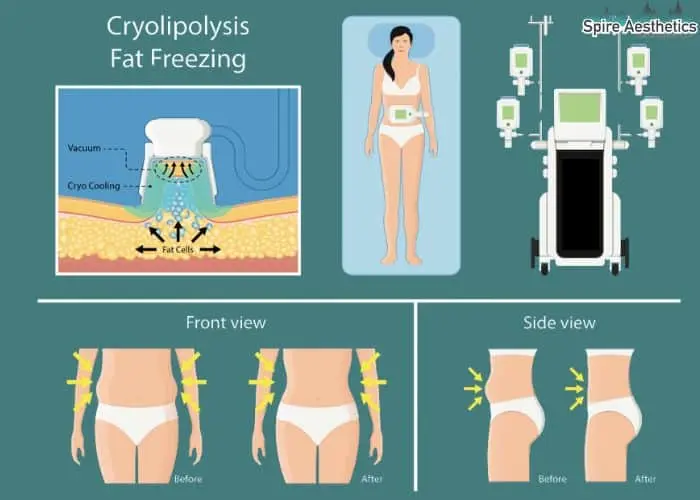 Fat freezing treatment Westminster benefits for competitions to remove stubborn fat deposits.