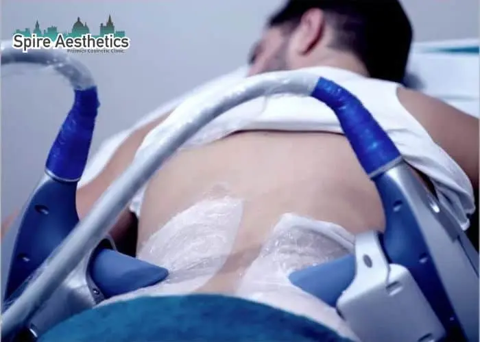 Man having fat freezing treatment done on love handles before a competitions Westminster to create a sculpted look.