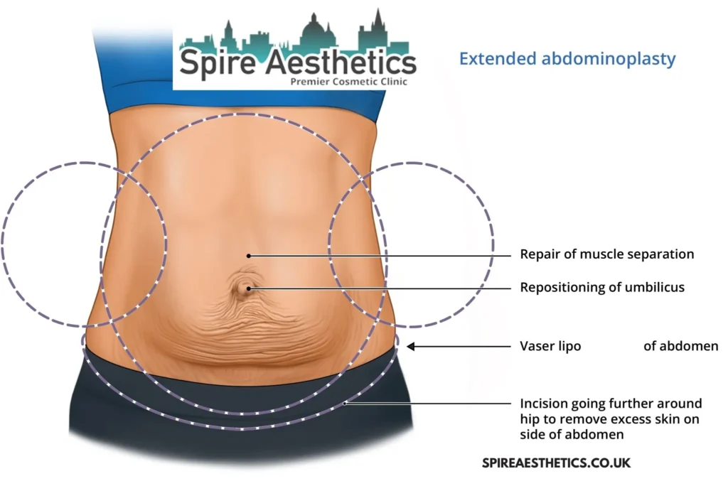 Understanding Loose Skin After Gastric Band Westminster Surgery and HIFU Treatment 