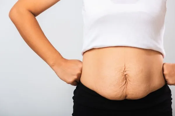 Image of a woman's stomach after weight loss with sagging skin following a gastric band Westminster
