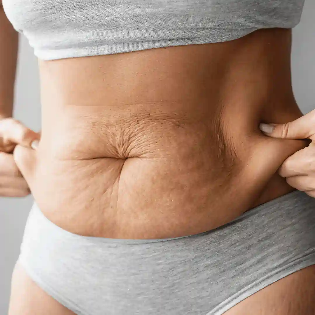 Is It Normal to Have Loose Skin After Pregnancy Westminster?