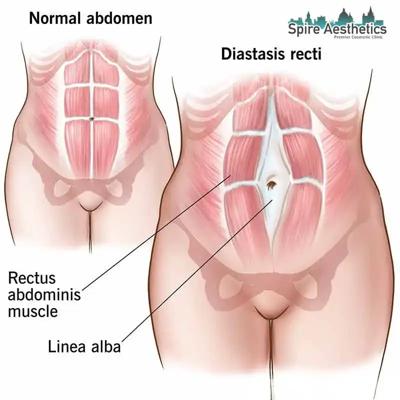 When Will My Belly Feel Normal Again Westminster?