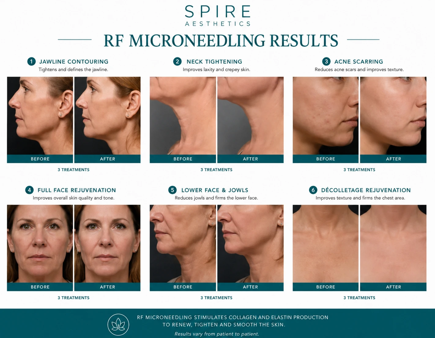 RF Microneedling Skin tightening Westminster results