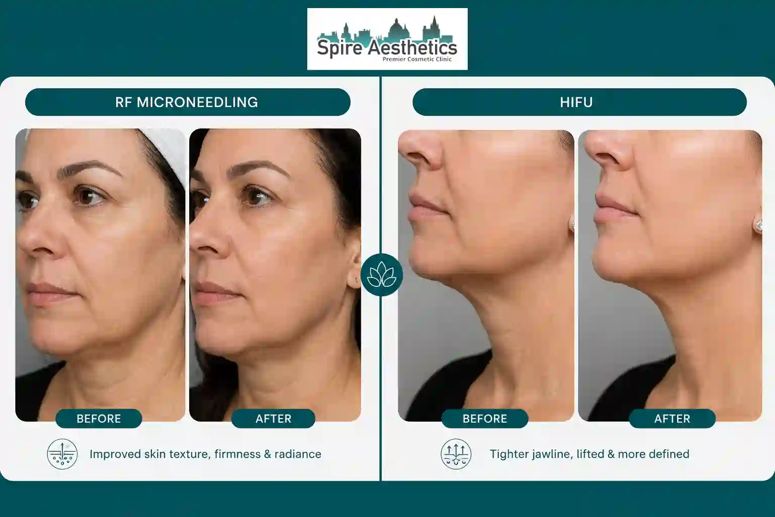 Can RF Microneedling and HIFU Be Combined Westminster?