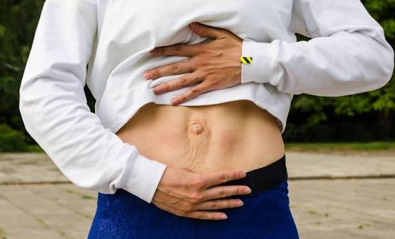 When Could Diastasis Recti Be the Missing Piece of the Puzzle Westminster?