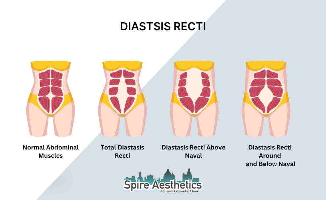 Is Non-Surgical Diastasis Recti Treatment Right for You? Common Concerns Answered Westminster